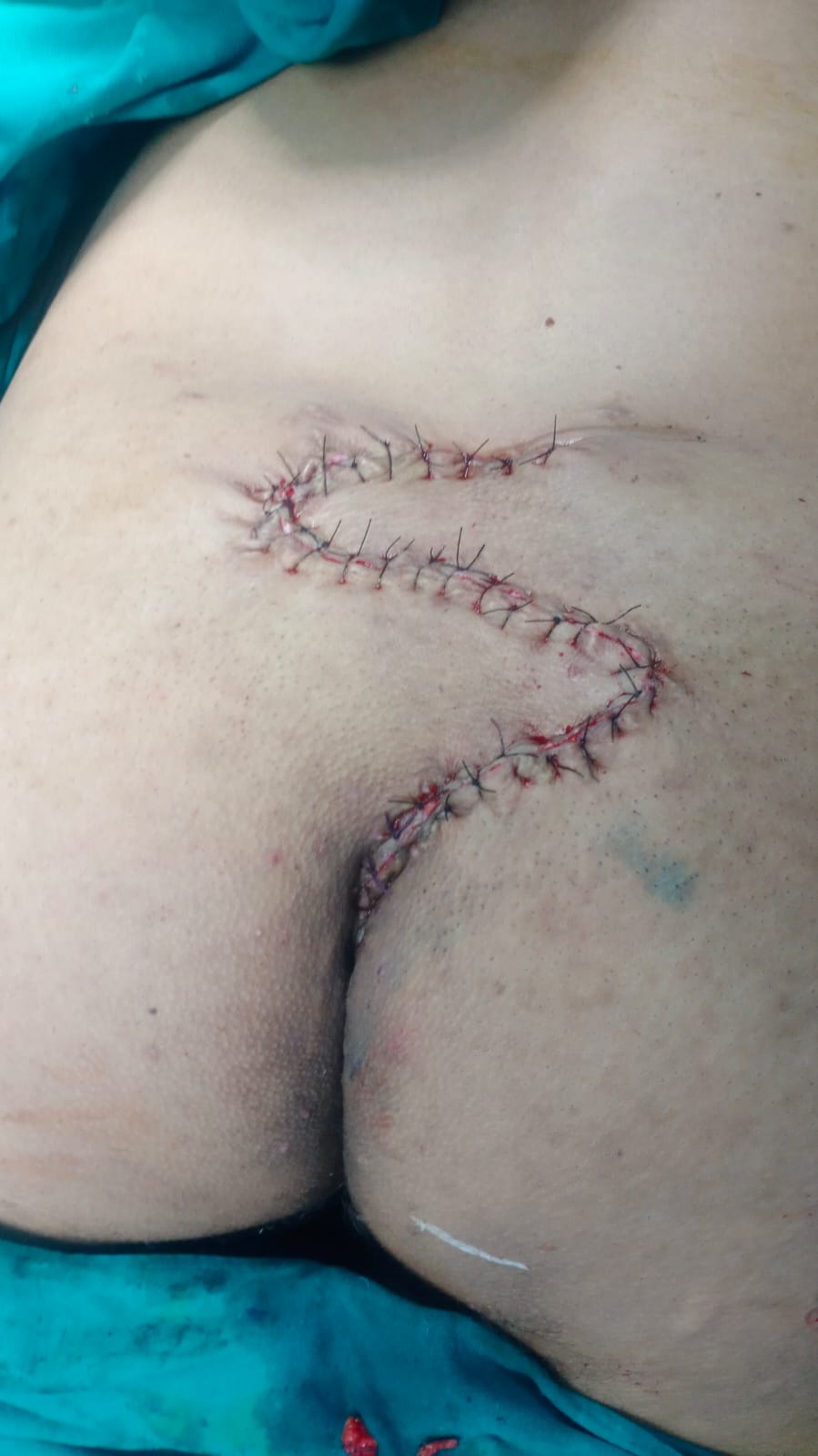 pilonidal sinus operation  