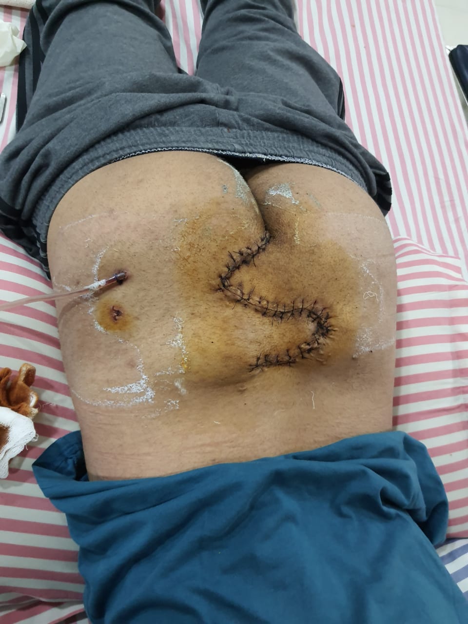 pilonidal sinus surgery