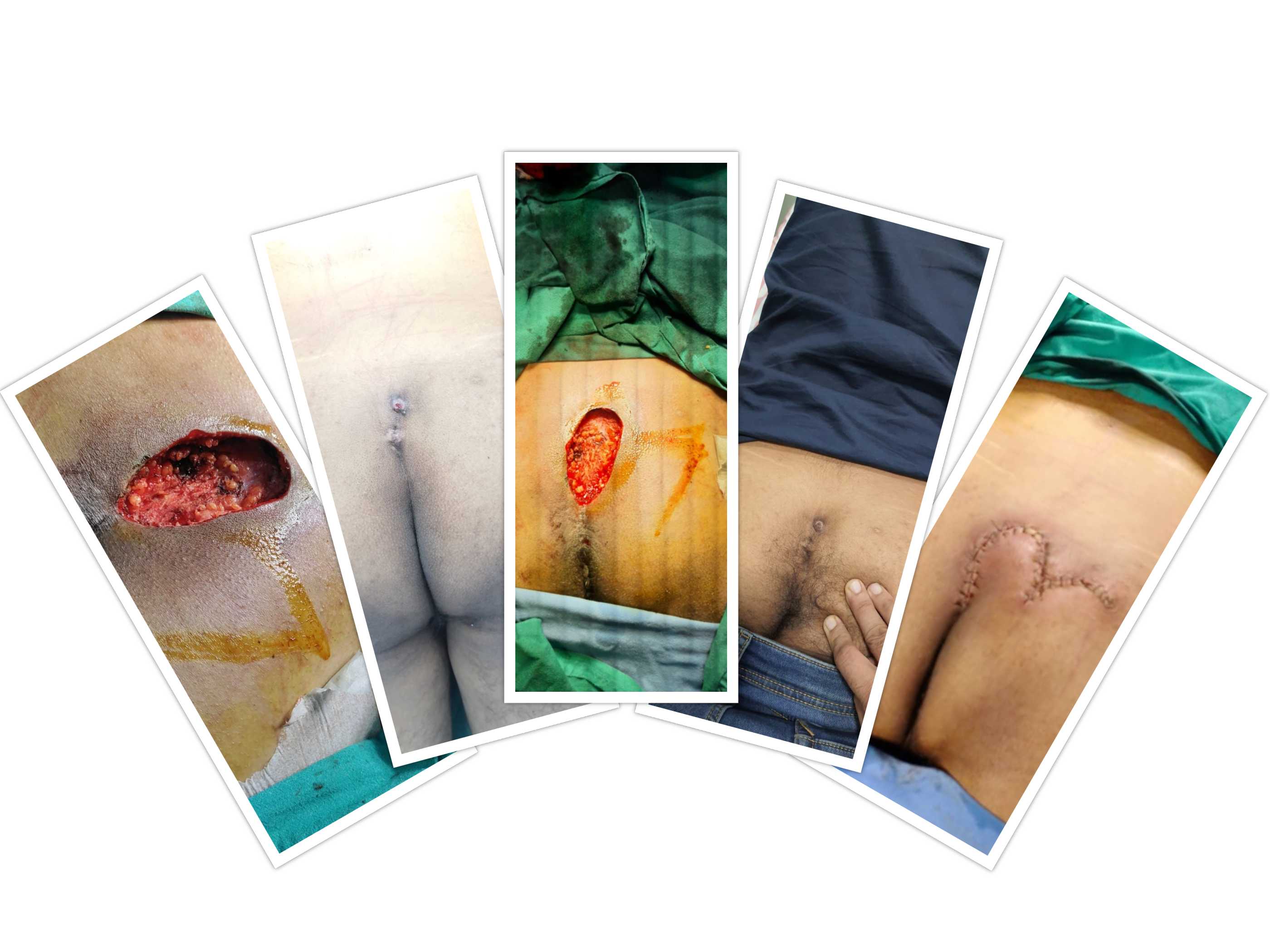 pilonidal sinus treatment