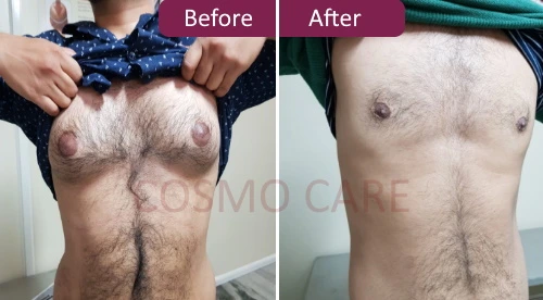 Gynecomastia Surgery