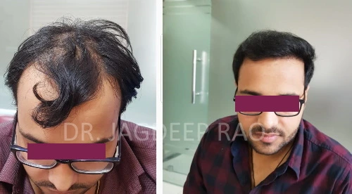 Handsome after Hair Transplant