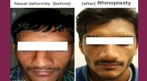 Rhinoplasty Surgery